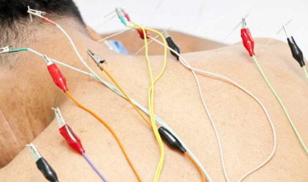 Electric Acupuncture