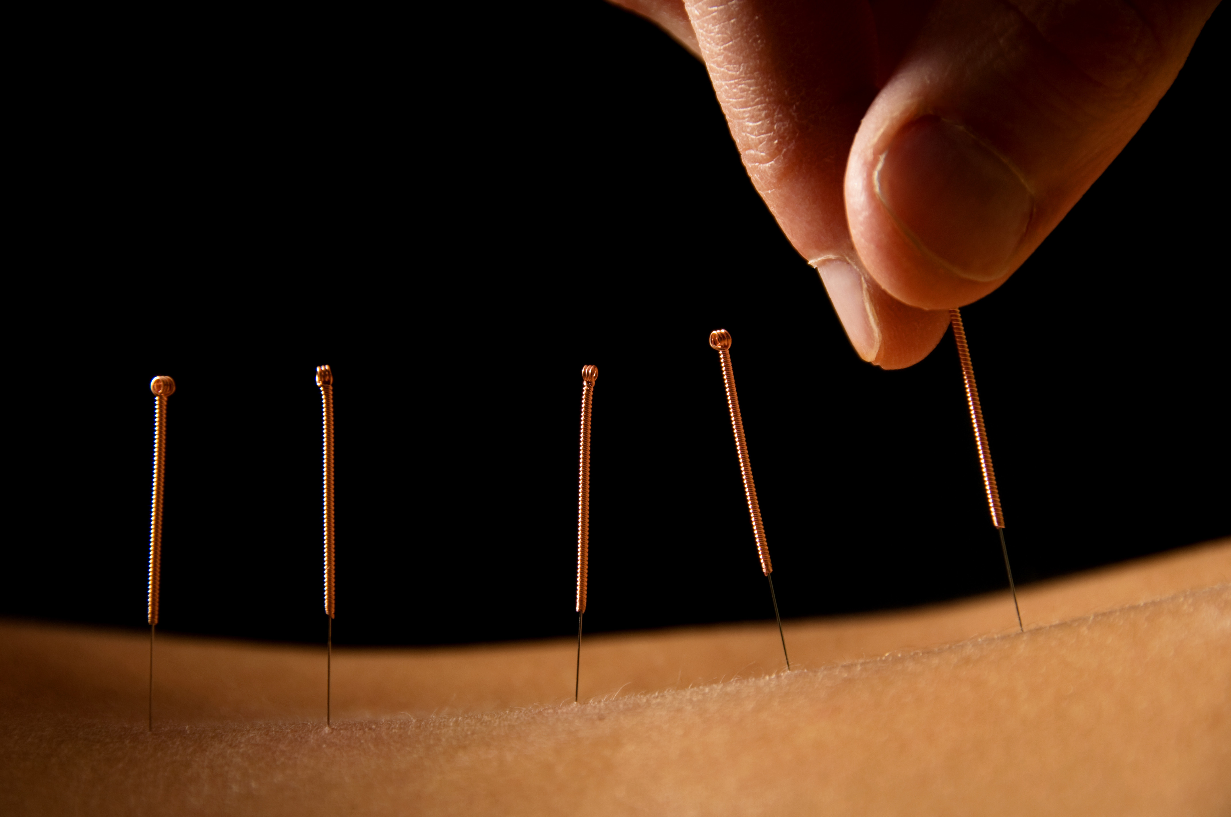 Acupuncture Treatment Acuayur